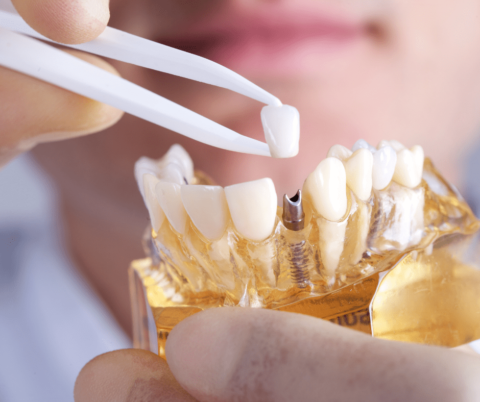 Tooth replacement options 