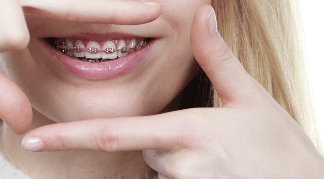 How Much Do Braces Cost Monthly? (It's less than you think)