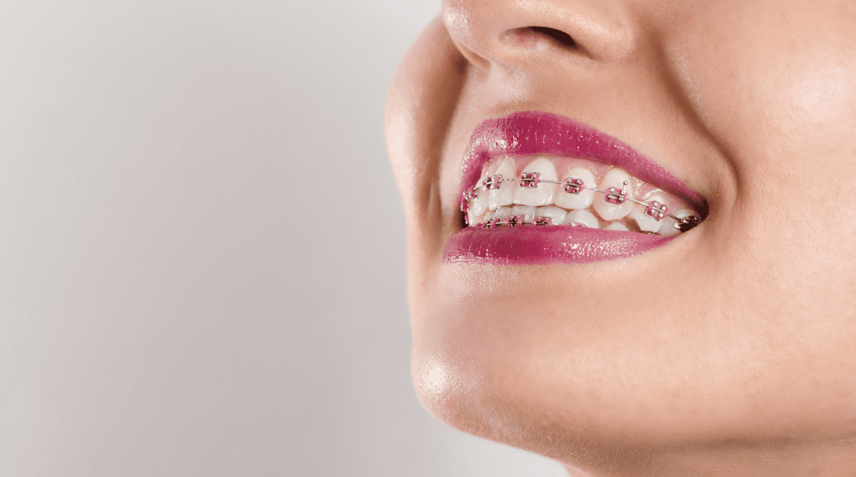 braces cost in the lower mainland 