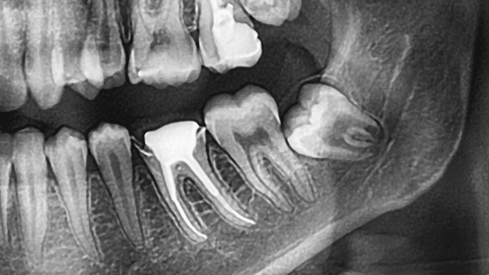 how much do wisdom teeth cost in coquitlam